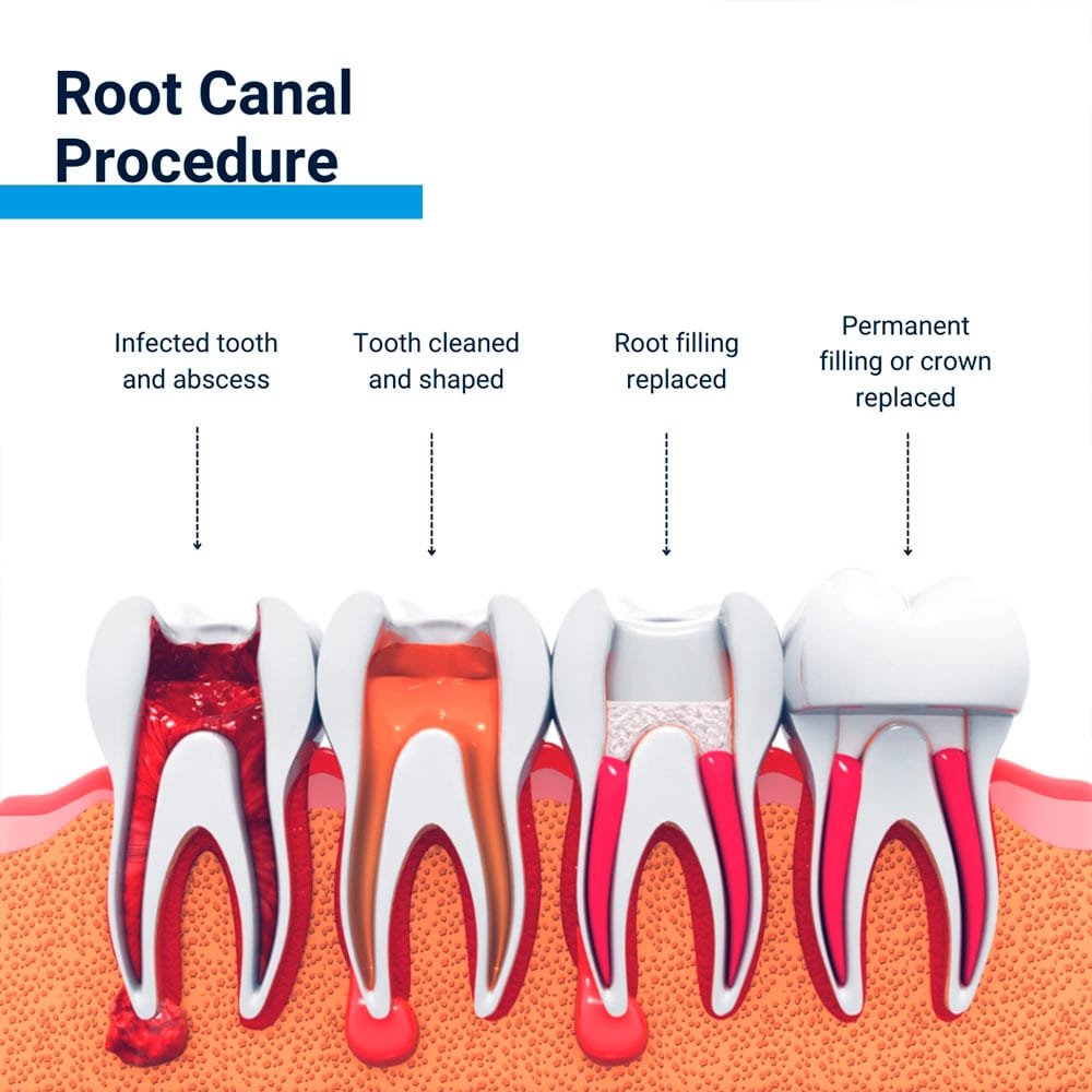 Root canal procedure steps - infected tooth, cleaning, root filling, and crown