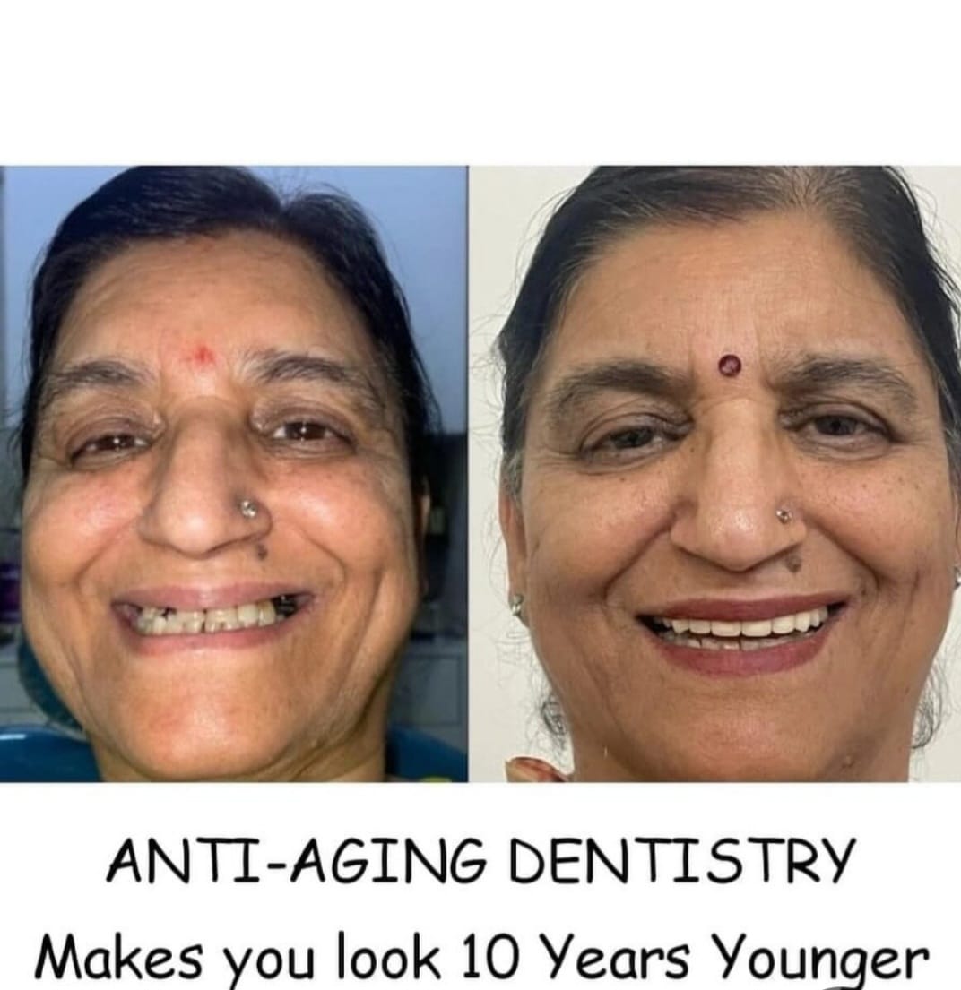 Smile Makeover Procedure