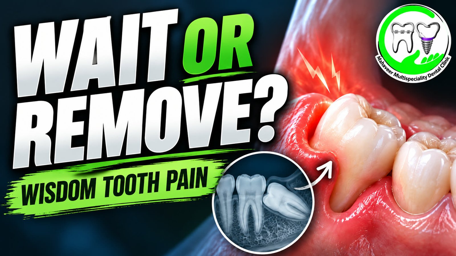 Dental X-ray style illustration representing wisdom tooth pain and impaction