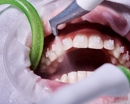 Dental cleaning