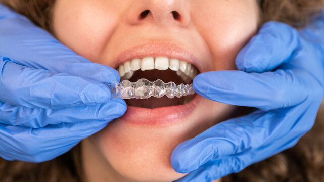 Invisalign clear aligners