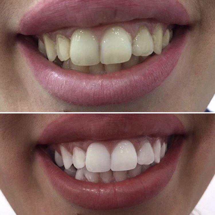 Teeth whitening